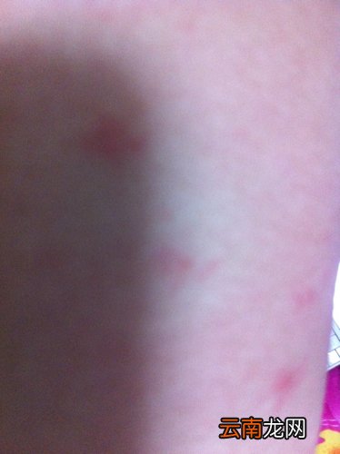 身上起了好多红疙瘩而且很痒怎么办?