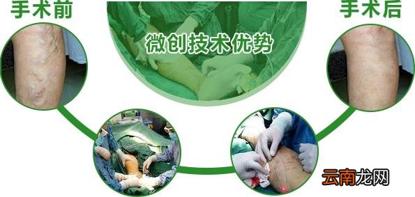 静脉曲张怎么治疗最好的方法