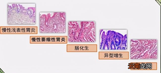 胃癌与胃炎如何鉴别