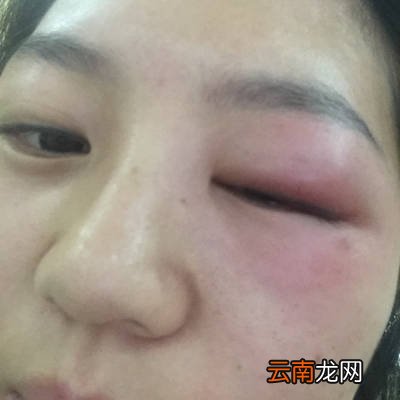 早上起床发现眼睛肿了，怎样才能迅速消除肿眼圈
