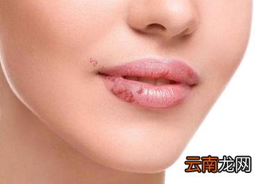 上火嘴唇起泡怎么办6个妙招快速降火