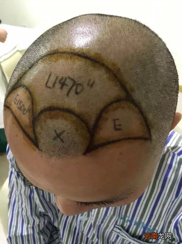 植发要多少钱一般