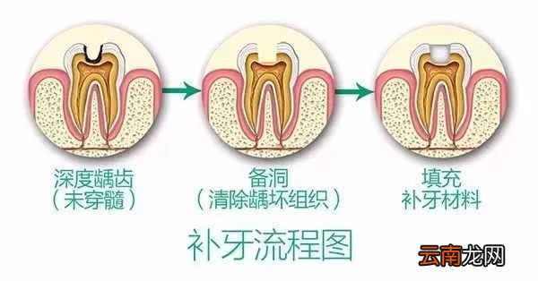补牙过程步骤