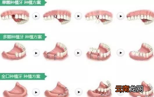 种植牙过程