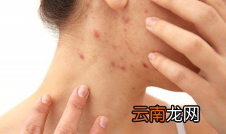 最快祛痘方法 快速祛痘方法有哪些