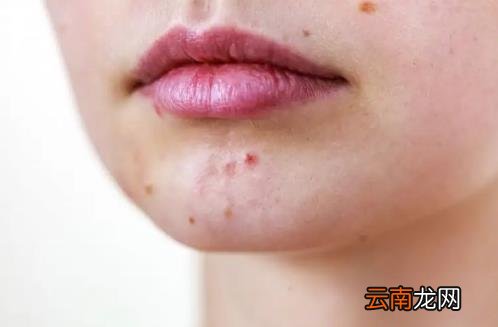 什么位置长痘痘分别代表什么 痘痘长的位置代表什么原因