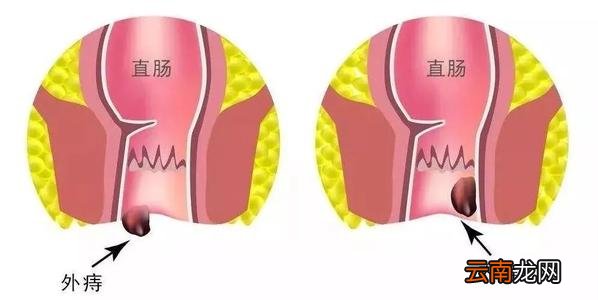 外痔疮最佳的自愈方法