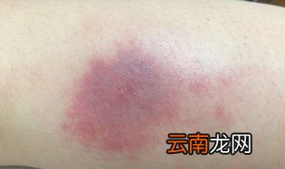 蚊子咬了红肿怎么止痒 可以涂什么东西