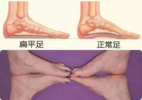 扁平足怎么判断