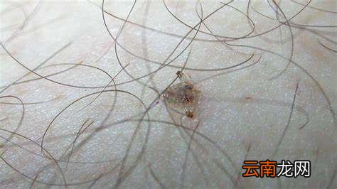 阴虱怎么去除选择哪种方法有效啊