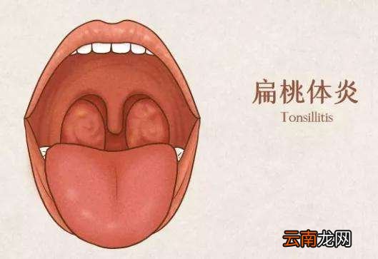 扁桃体发炎怎么办最简单的方法