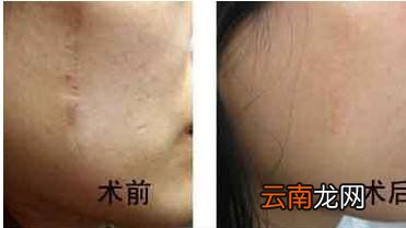 疤痕修复手术要多少钱