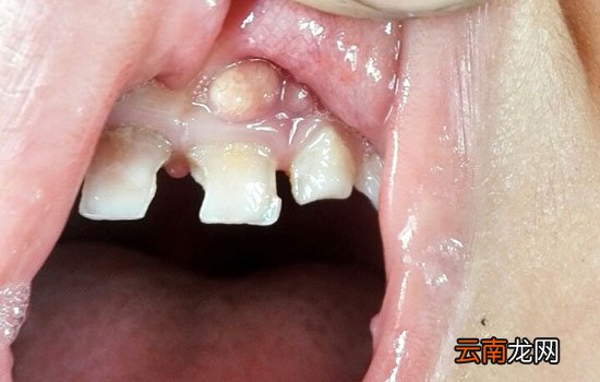 宝宝上牙龈鼓牙包是怎么回事