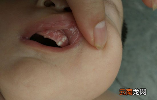 宝宝上牙龈鼓牙包是怎么回事