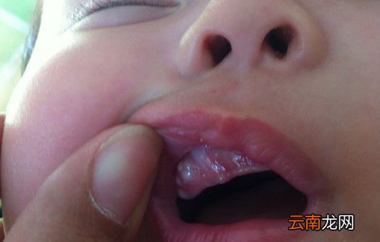 宝宝上牙龈鼓牙包是怎么回事