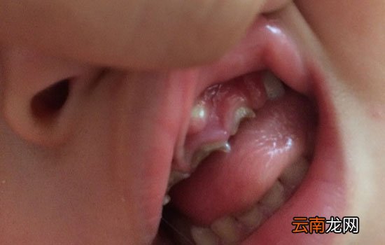 宝宝上牙龈鼓牙包是怎么回事