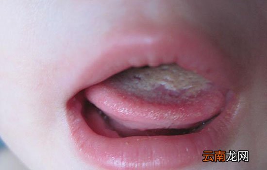 鹅口疮和奶垢的区别 家长注意这四大不同点