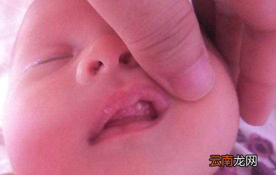 鹅口疮和马牙的区别 从五个方面来区分
