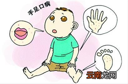 手足口病一定会发烧吗 手足口病发烧能吃退烧药吗