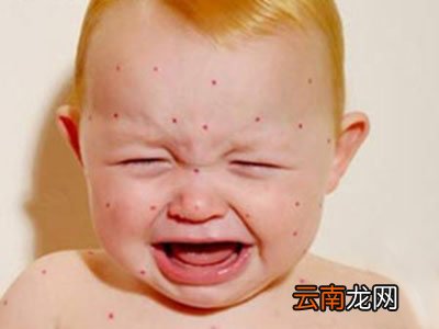 宝宝长水痘怎么治疗 宝宝长水痘护理方法