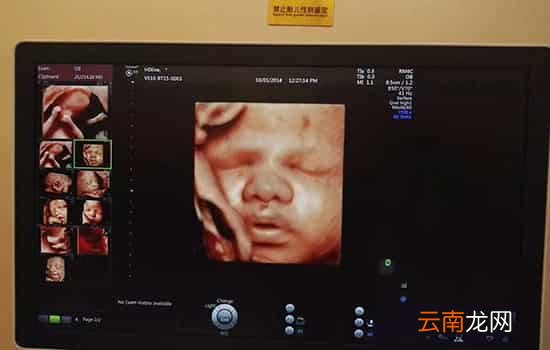 兔唇能在孕检检查出来吗 基本都能检查出来
