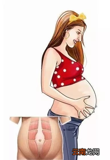 什么是产后腹直肌分离 如何自查呢