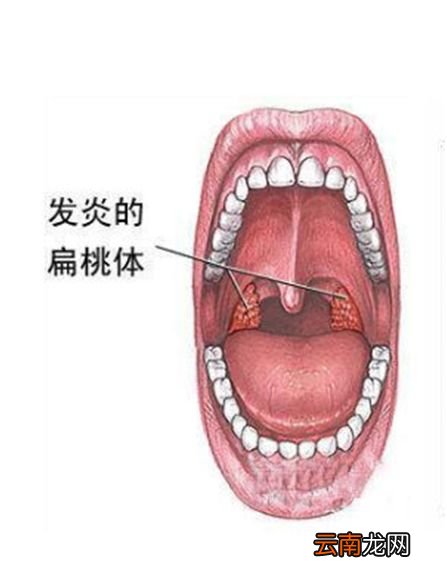宝宝扁桃体发炎怎么治 宝宝扁桃体发炎治疗法