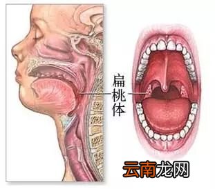 宝宝扁桃体发炎怎么治 宝宝扁桃体发炎治疗法