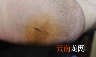 被钉子扎到脚怎么办 被钉子扎到脚的方法