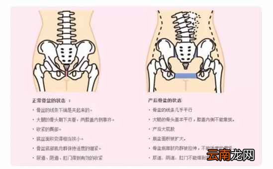 产后盆骨变大怎么办 盆骨修复可是很有必要哟