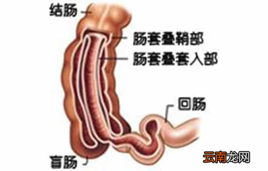 肠套叠的三大典型症状 家长应警惕这三大症状