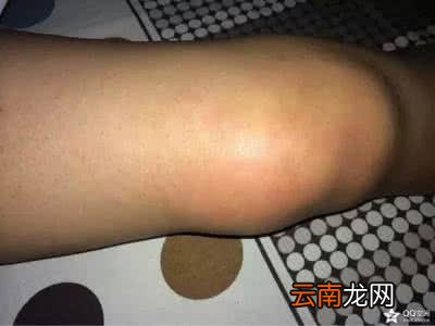 膝关节损伤如何恢复呢