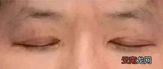 心脏不好有什么症状 看脸就知道了