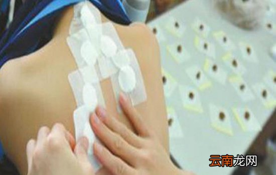 三伏贴可以自己贴吗 并不提倡自己在家贴三伏贴