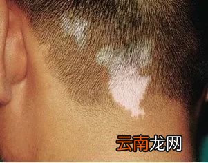白癜风有什么症状 你也能轻易识别