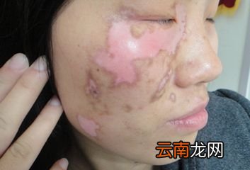 白癜风有什么症状 你也能轻易识别