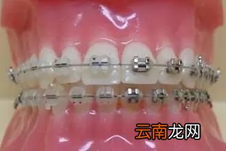 牙缝越来越大怎么回事 缝隙越来越大怎么办