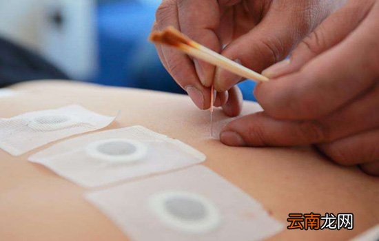 三伏贴贴多久撕掉 长时间贴敷更容易起水泡