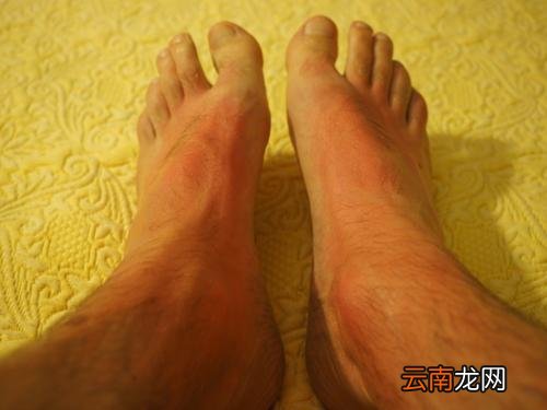 用陈醋泡脚比例是多少,用陈醋泡脚有什么好处