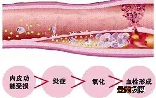 血管硬化的原因 关于血管硬化的几个小问题