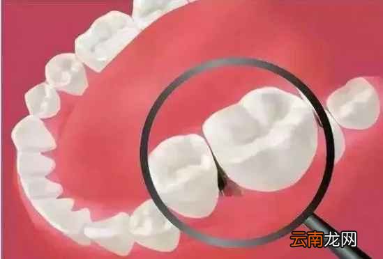 经常塞牙是什么原因 塞牙的危害可不能忽视