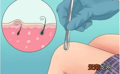 解决“毛发内生”的困扰 下面这些方法可帮你