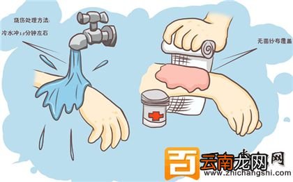 烫伤起泡怎么办？轻重度烫伤的急救处理常识