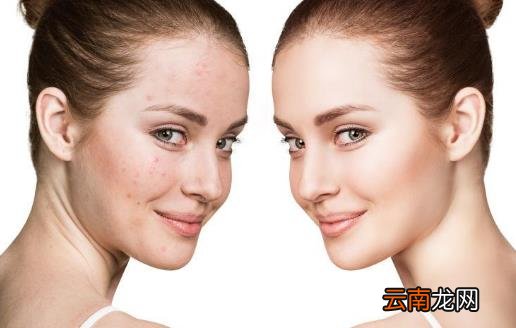 脸部经常出油的人更不健康 护理油性肌肤有妙招