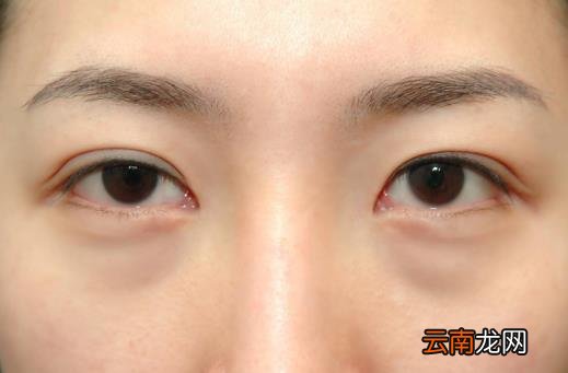 祛除眼袋小方子大推荐 让你今夏眼袋全无年轻十岁
