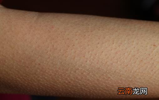 皮肤不平整总起鸡皮疙瘩 教你消鸡皮让皮肤恢复光滑