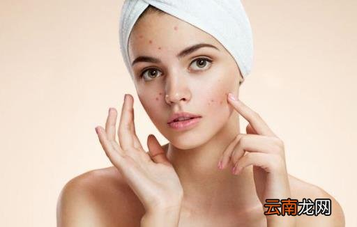 是否你的脸上长痘痘迟迟不消 小心这是粉瘤来袭