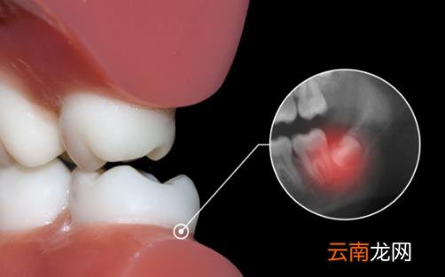拔智齿减少疼痛需要做好的工作 拔除智齿需知的常识