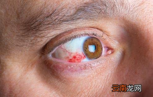 导致红血丝过多的原因 眼睛红血丝需多冷敷眼部降温