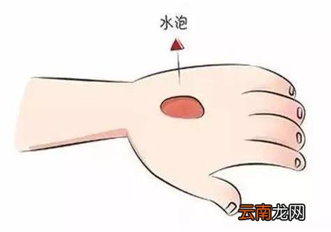 烫伤的水泡能挑破吗 科学处置烧烫伤方法